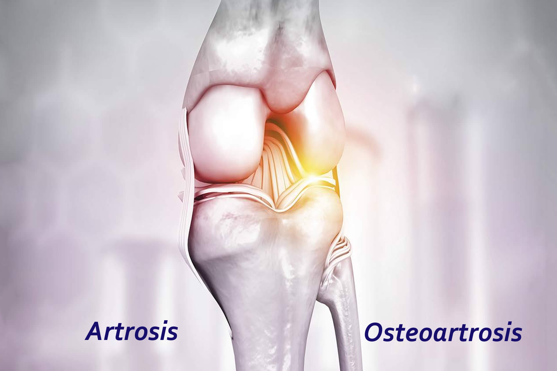 ARTROSIS OSTEOARTROSIS GUAYAQUIL SAMBORONDÓN